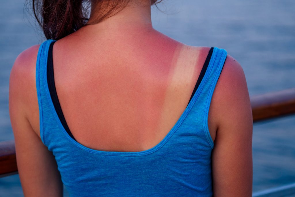 Sonnenbrand auf Stellen des Gesichts und der Schulter sind häufig. Hier abgebildet ist eine Schulter mit deutlichem Sonnenbrand.