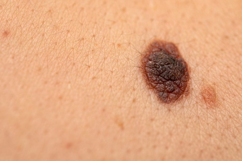 Nahaufnahme eines gefährlichen braunen Naevus auf der menschlichen Haut – Melanom